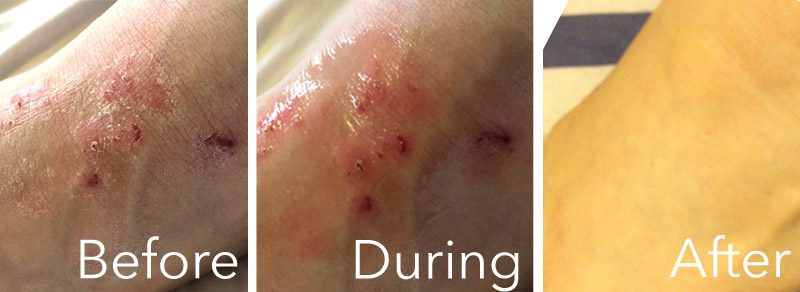ziajamed atopic dermatitis before after