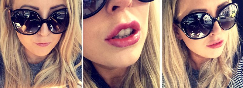 avoca clinic lip fillers before and after2