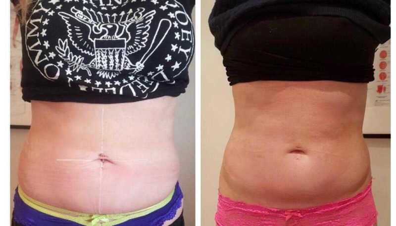 3D Lipo before after