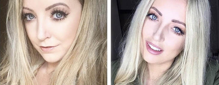 Before and After clearbraces and lip fillers